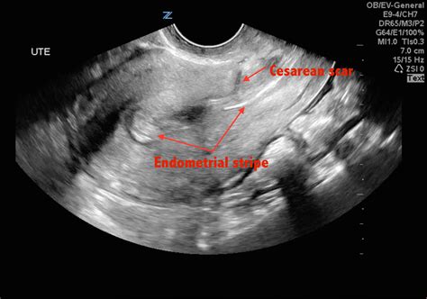 ultrasound for cesarean section scar